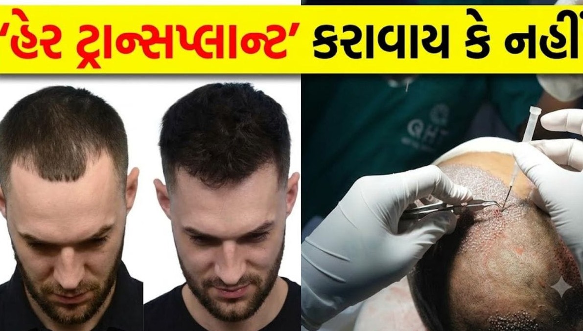 વાળ પ્રત્યારોપણ કરાવતા પહેલાં ચેતજો: બેદરકારી રાખશો તો ભારે પસ્તાવો થશે, જાણો જોખમો અને જરૂરી સાવચેતી
