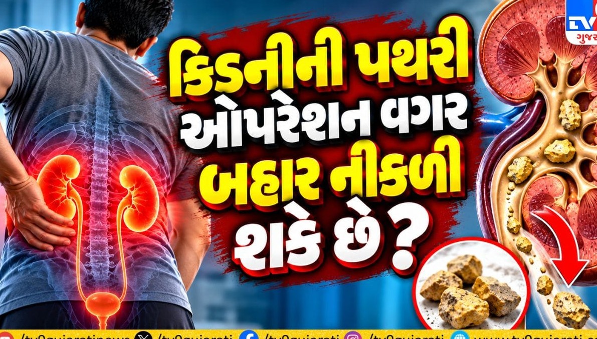 કિડનીની પથરીમાં ક્યારે જરૂરી બને છે સર્જરી? જાણો કદ અને કુદરતી નિકાલ અંગે તબીબી તારણો