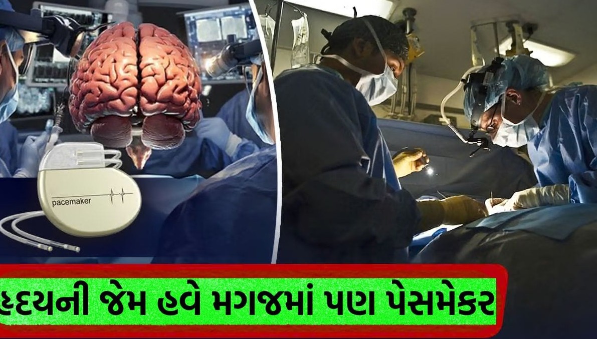 હૃદયની જેમ હવે મગજમાં પણ પેસમેકર: દિલ્હીની હોસ્પિટલમાં પહેલીવાર સફળ થઈ ડીપ બ્રેઇન સર્જરી